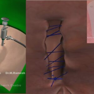 Laparoscopic Hernia Training Course