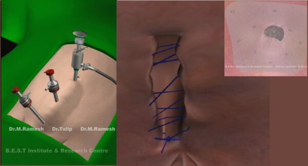 Laparoscopic Hernia Training Course